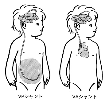 シャント は vp と